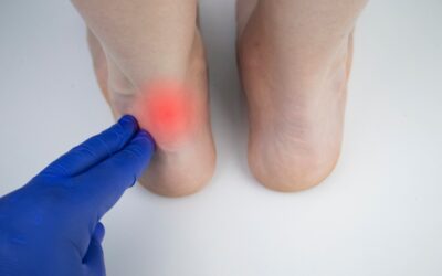 Achilles Heel Pain and Treatment Options